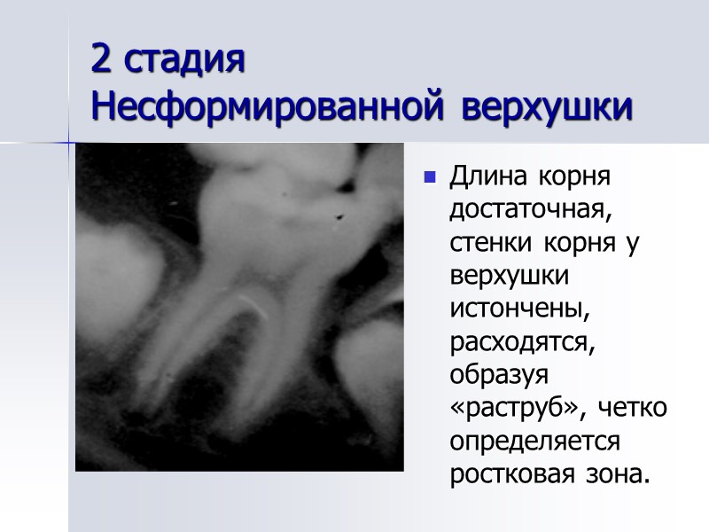 2 стадия  Несформированной верхушки  Длина корня достаточная, стенки корня у верхушки истончены,
